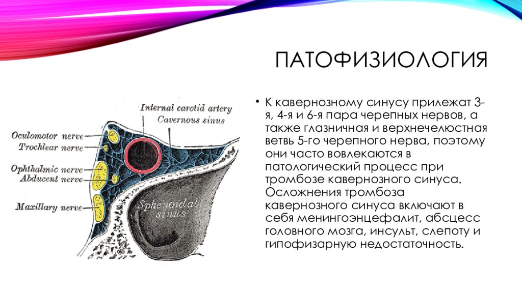 Тромбоз кавернозного синуса