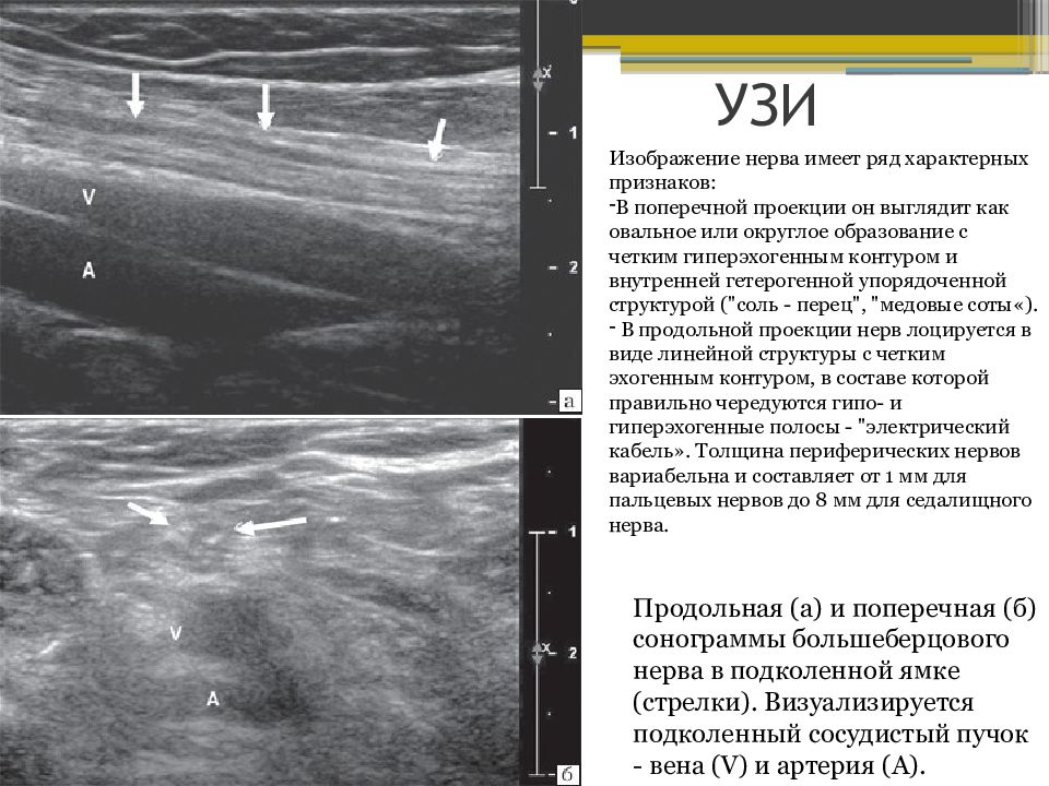 Что покажет узи нервов. Поражение периферических нервов нижних конечностей. Поражения периферических нервов и корешковые синдромы,. Переходный стил синдром на УЗИ.