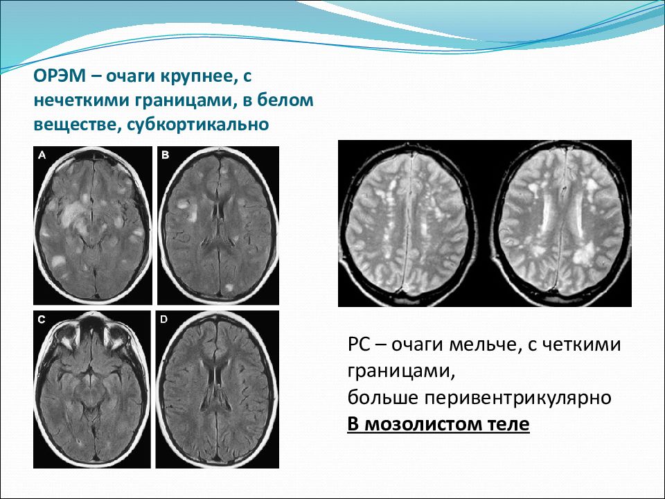 Острый рассеянный энцефаломиелит презентация