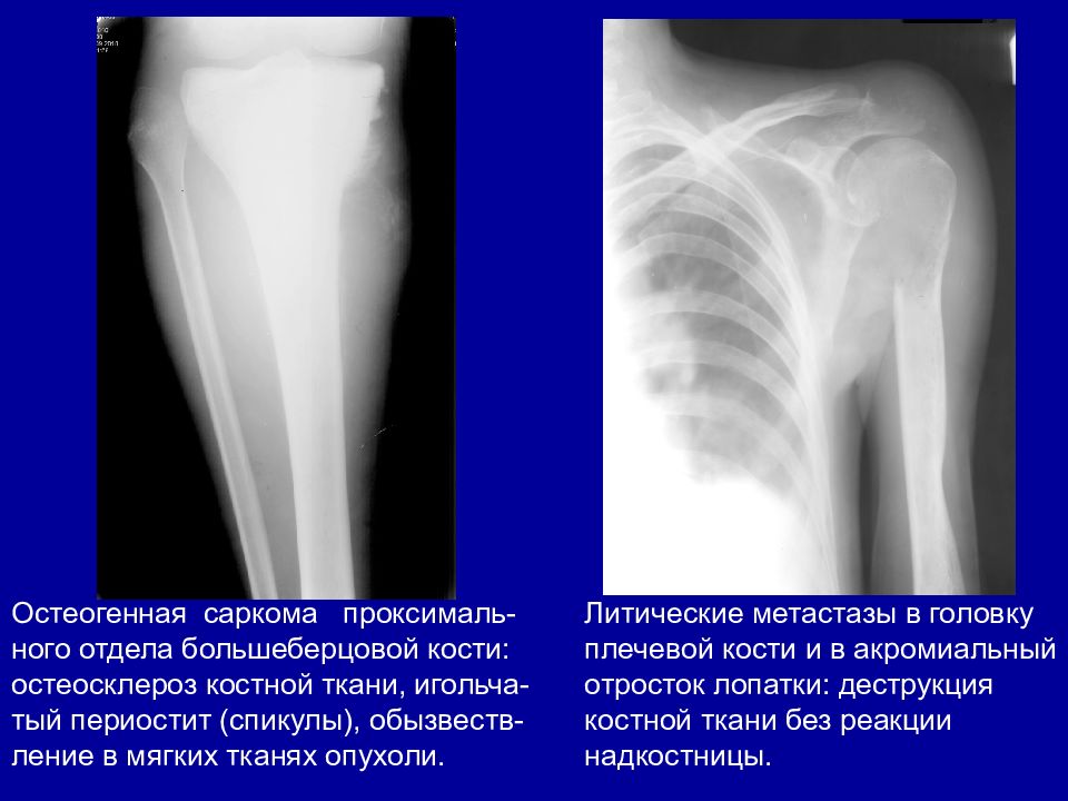 Остеосклеротические очаги в костях