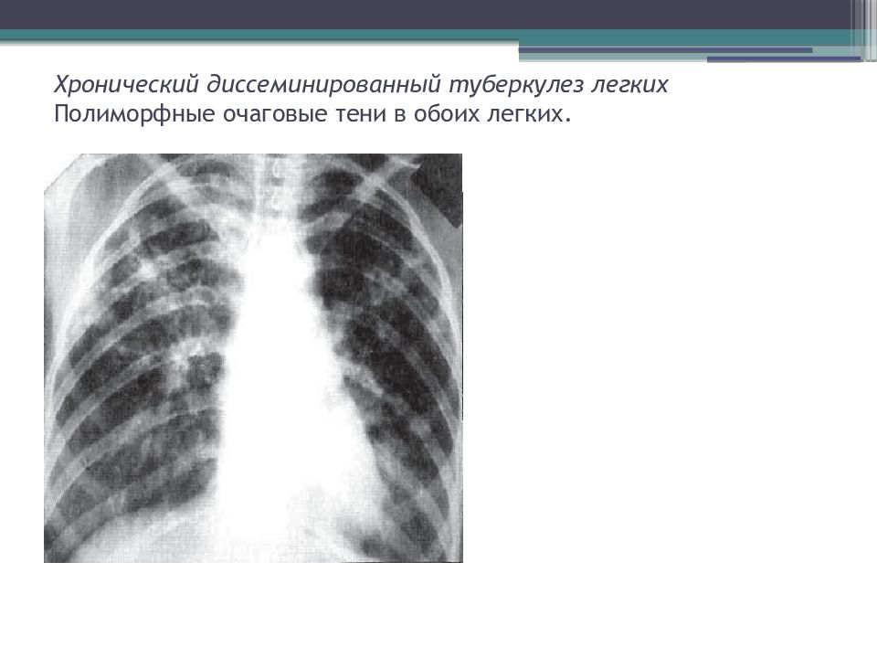 Тень в легких. Хронический диссеминированный туберкулез легких рентген. Хронический диссеминированный туберкулез рентген. Диссеминированный туберкулез легкого рентген. Очаговый и диссеминированный туберкулез.