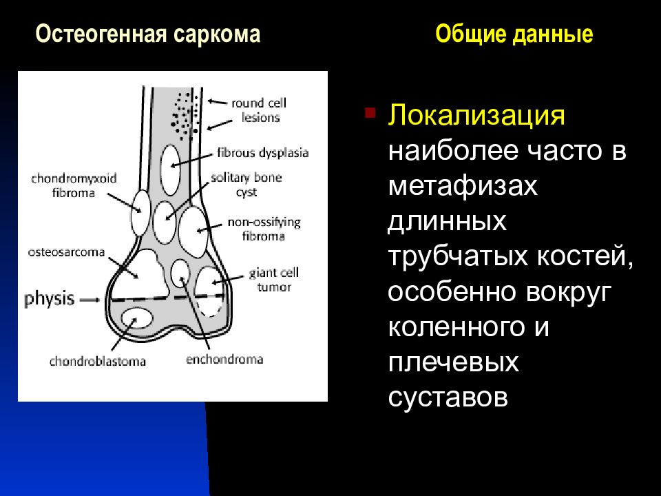 Саркомы костей тест нмо. Остеогенная саркома локализация. Саркомы костей локализация. Остеогенная саркома рентгенологические признаки. Остеогенная саркома схема.