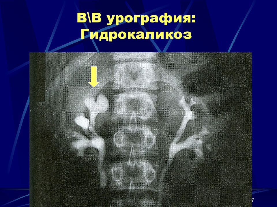 Каликоэктазия почек. Гидрокаликоз почек рентген. Гидрокаликоз почек на УЗИ.
