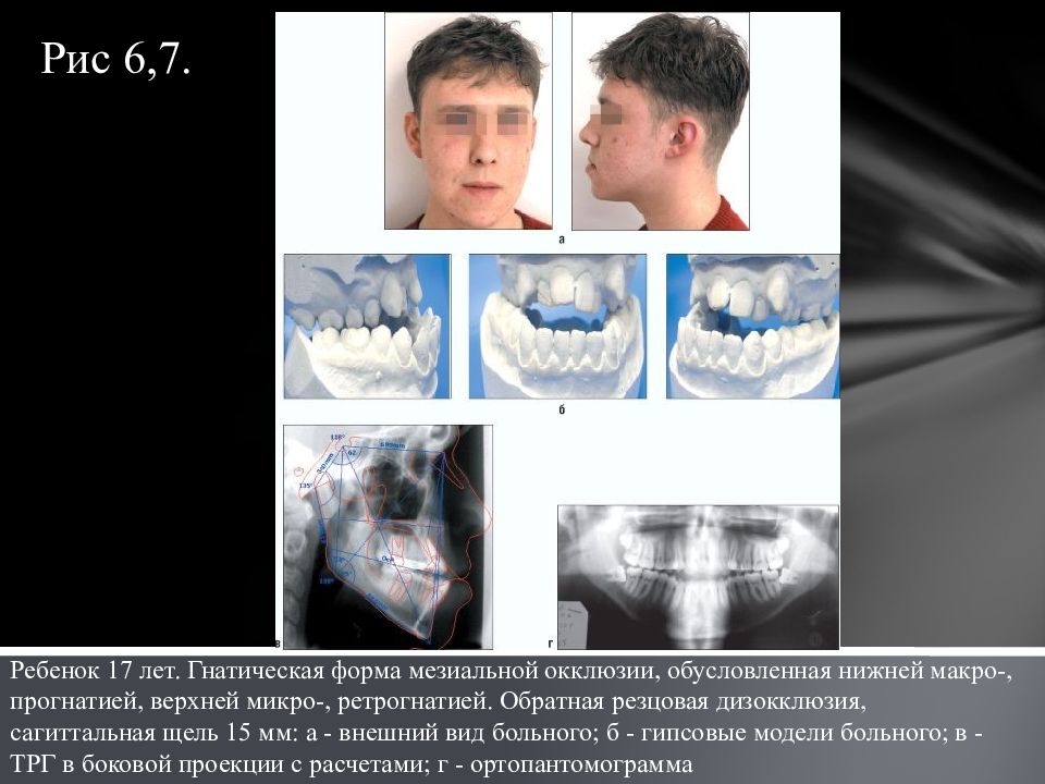 Мезиальный прикус презентация