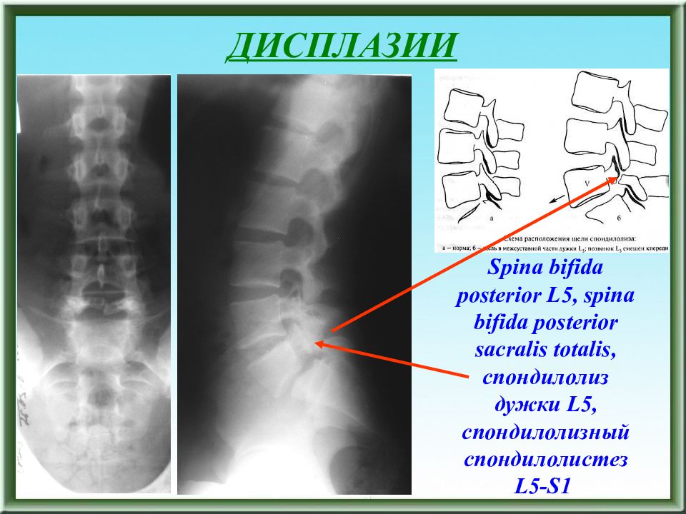 Spina. Спина бифида Постериор l5. Незаращение дужки l5 рентген. Незаращение дужки l5 позвонка рентген.