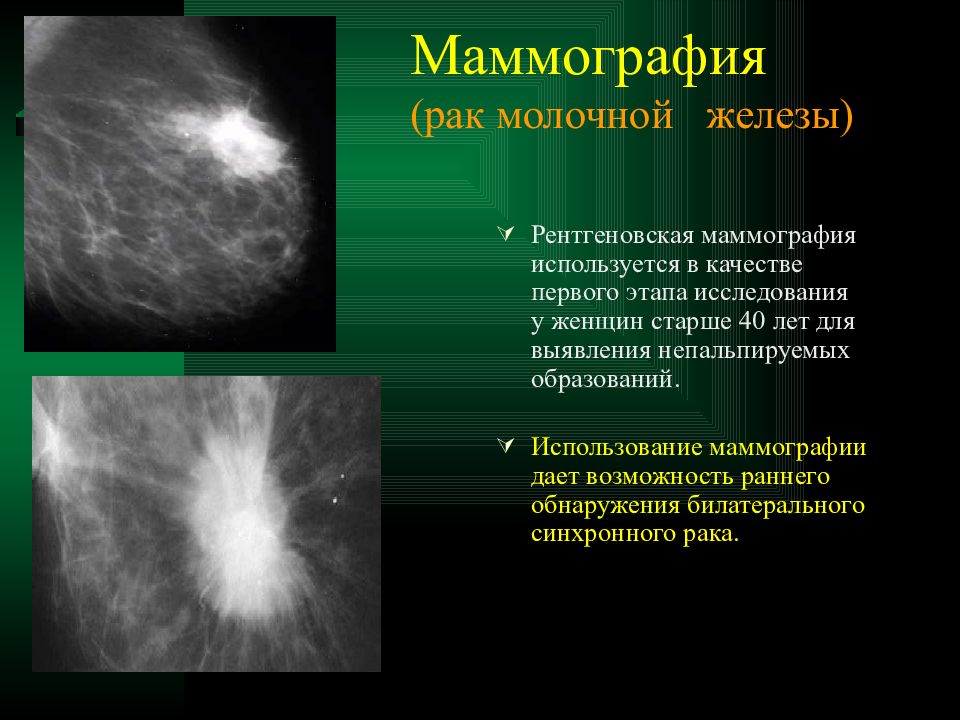 Маммографию после флюорографии. Маммография молочных желез объемное образование. Опухоль молочной железы. Онкология молочной железы. Опухольмолочныйжелезы.