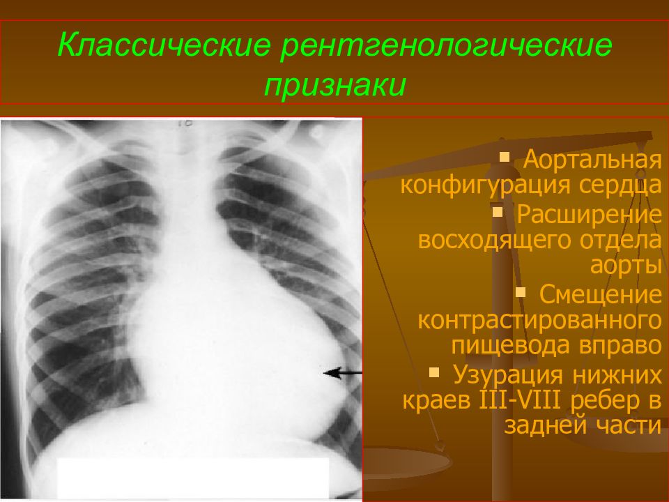 Рентгенологическая картина при митральном стенозе