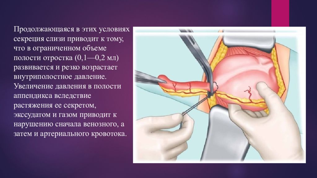 Осложнения аппендицита