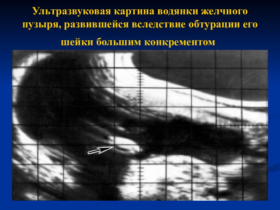 Влияет ли химический состав конкремента желчного пузыря на ультразвуковую картину конкремента тест