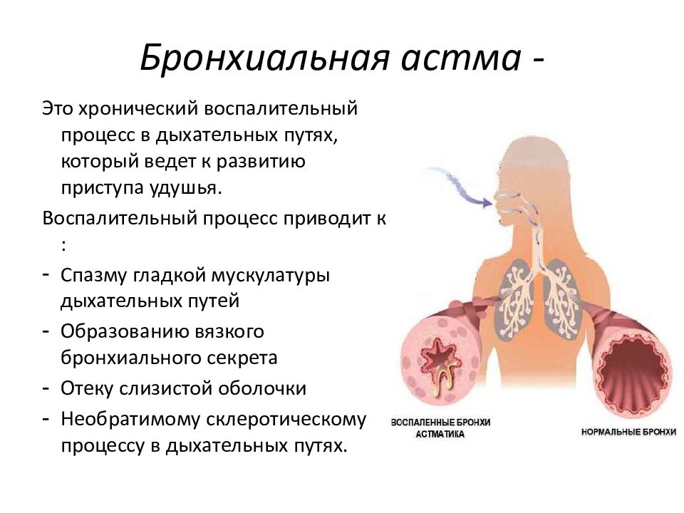 Астматический статус картинки