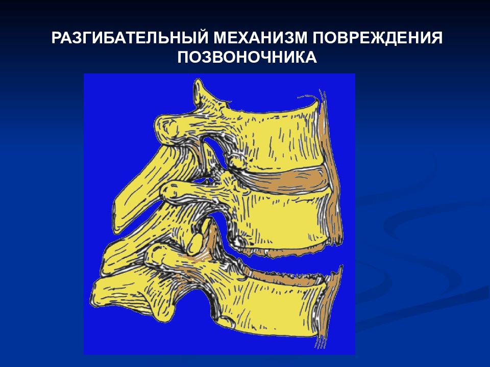 Повреждение позвоночника. Сгибательно-вращательный механизм повреждения позвоночника. Сгибательный механизм травмы позвоночника. Перелом позвоночника механизм повреждения. Разгибательный механизм повреждения позвоночника.