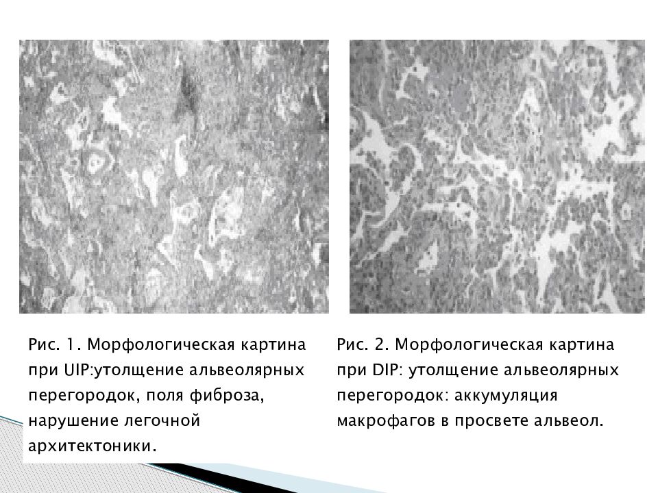 Нити фиброза. Морфологическая картина это. Мукоидное набухание в альвеолярных перегородках. Нарушение архитектоники. Типы альвеолярных клеток.