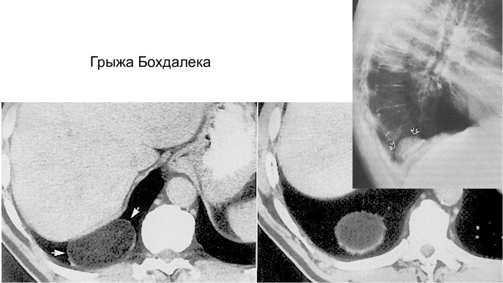 Грыжа бохдалека. Диафрагмальная грыжа на кт.