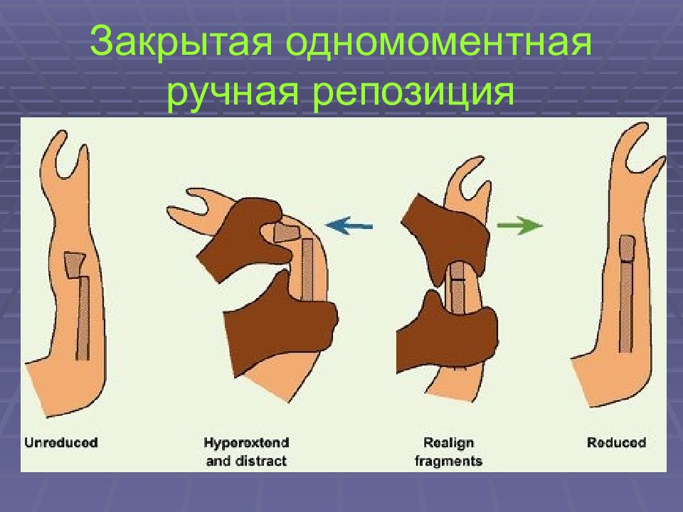 Карта вызова смп перелом лучевой кости закрытый