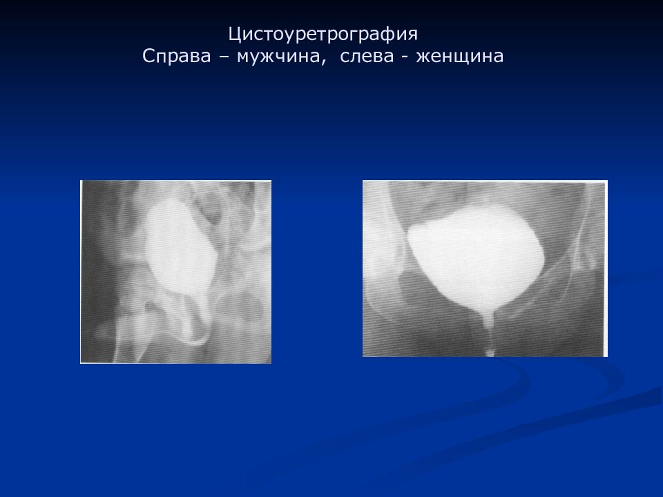 Цистография мочевого пузыря рентген. Ретроградная цистография.