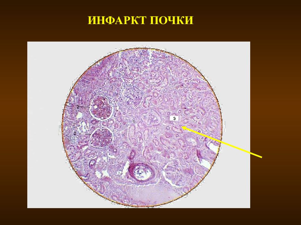 Ишемический инфаркт. Анемический (ишемический) инфаркт почки:. Ишемический инфаркт почки гистология. Ишемический инфаркт почки препарат. Ишемический инфаркт почки микропрепарат.