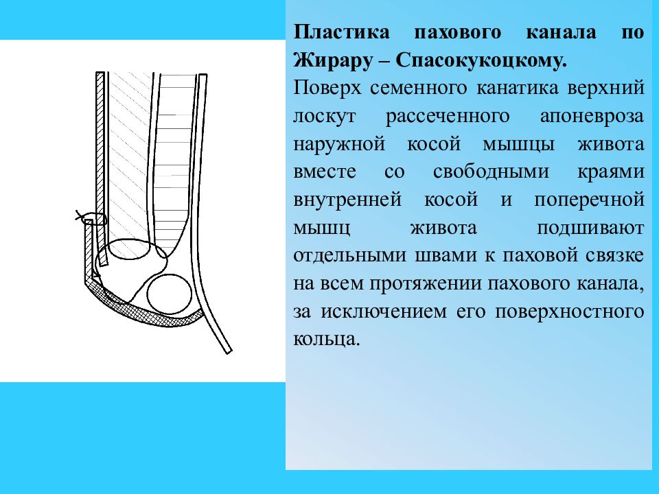 Стенки пахового канала