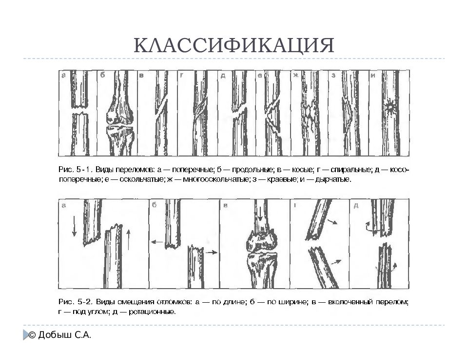 Продольный и поперечный рисунок. Классификация переломов по линии излома. Классификация переломов со смещением. Классификация переломов по линии перелома. Классификация переломов по смещению отломков.