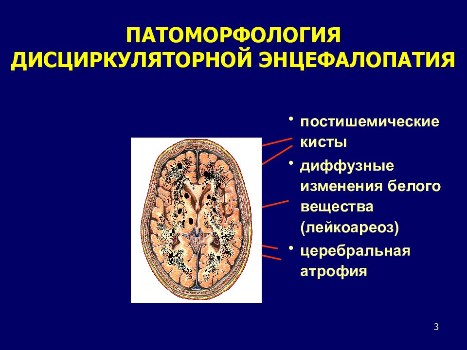 Картина дисциркуляторной энцефалопатии что это