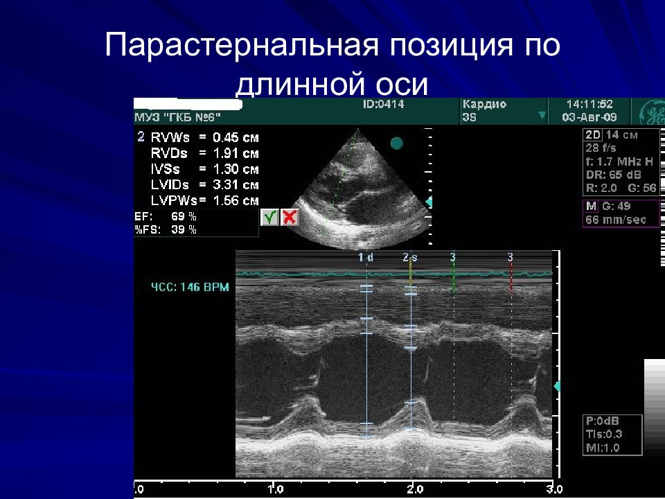 Эхографическая картина неизмененной аорты при поперечном сканировании тест