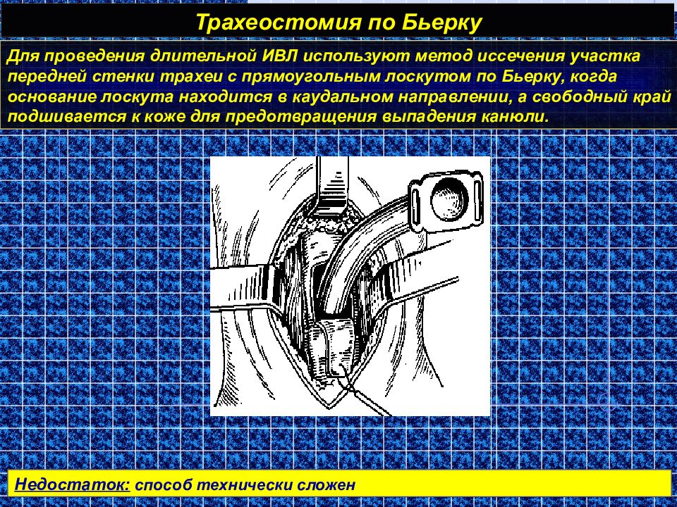 Наложение трахеостомы. Продольная трахеостомия. Трахеостомия по Бьерку. Створчатая трахеостомия по Бьерку. Методика выполнения трахеостомии.