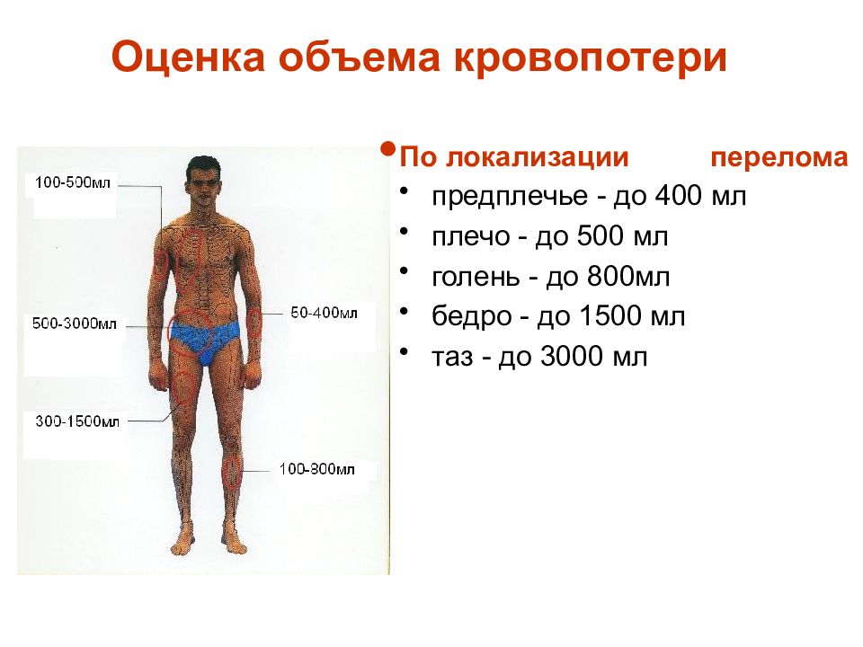 Объем человека. Оценка объема кровопотери. Объем кровопотери по локализации переломов. Кровопотеря при переломах. Кровопотеря при переломах костей.