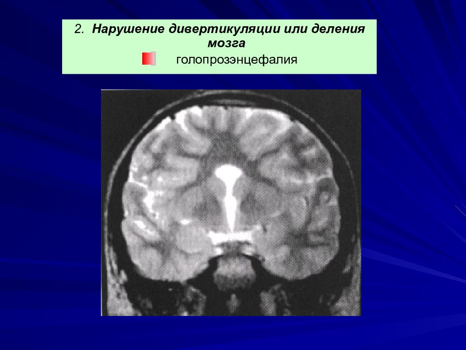 Шизэнцефалия мрт картинки