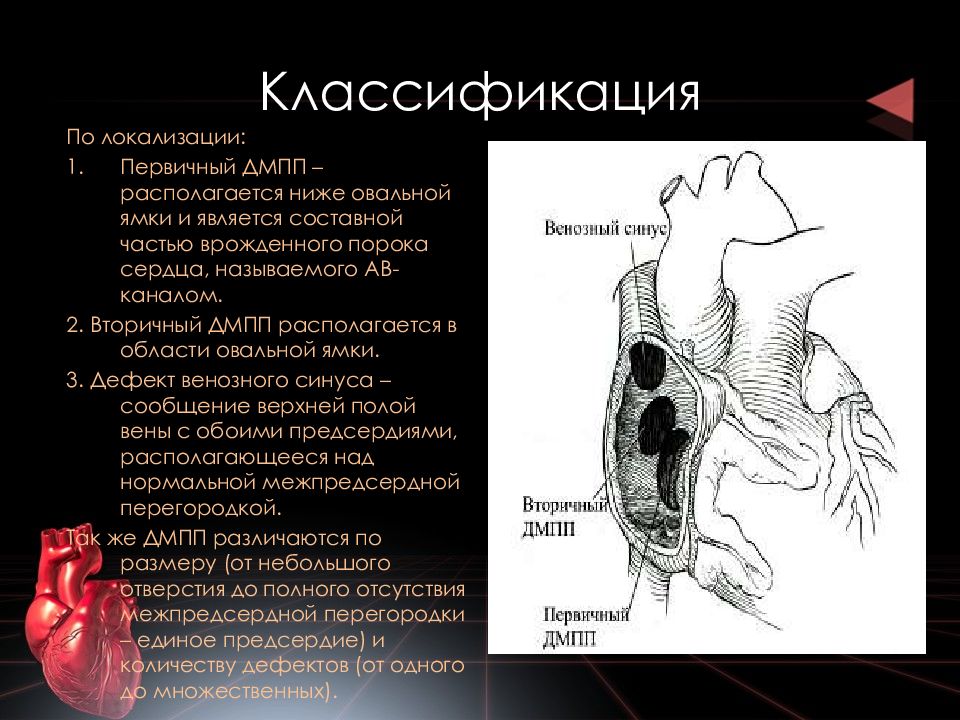 Пороки сердца межпредсердной перегородки. Первичный дефект межпредсердной перегородки. Врожденный порок межсердечной перегородки. Дефект межпредсердной перегородки классификация. Дефект межпредсердной перегородки вторичного типа.