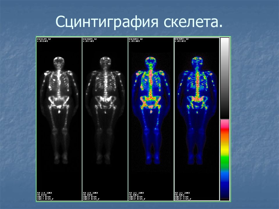 Сцинтиграфия скелета. Сцинтиграфия. Аппарат для сцинтиграфии костей скелета. Сцинтиграфия позвоночника. Сцинтиграфия костей скелета с технецием.