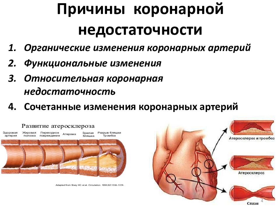 Коронарная недостаточность презентация