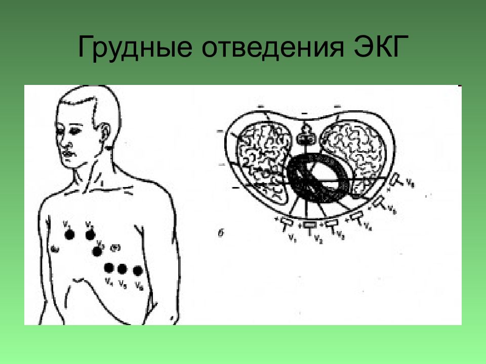 Снятие экг отведения