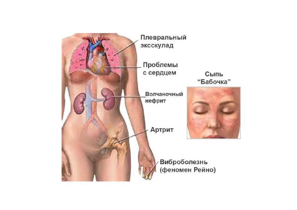 Скв у детей презентация