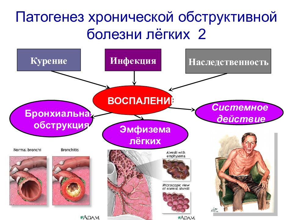 Хроническая обструктивная болезнь легких картинки