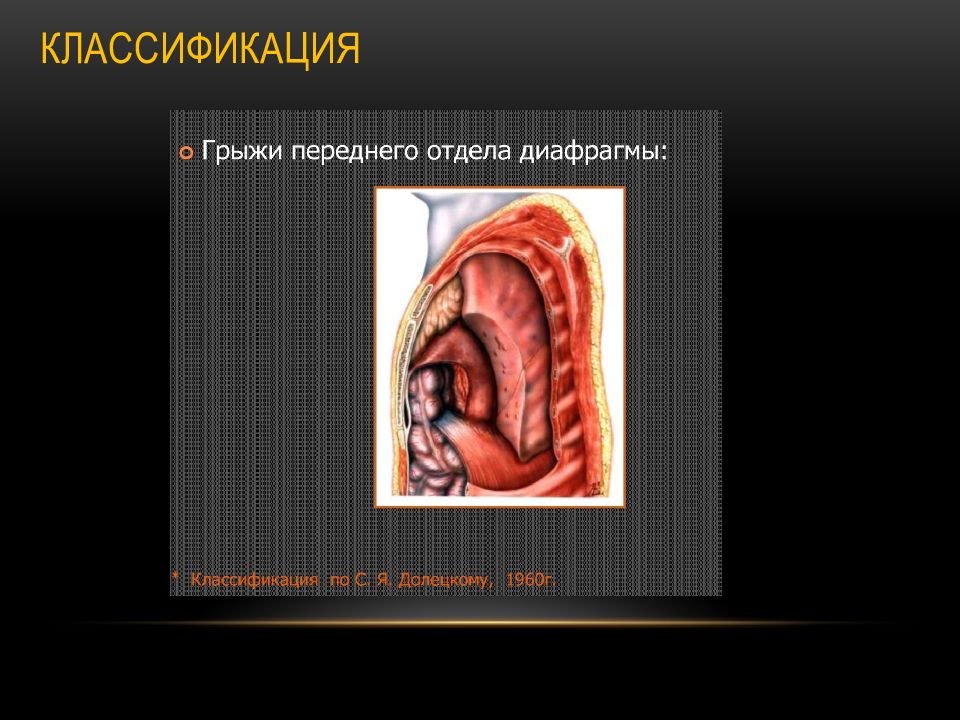 Диафрагмальные грыжи презентация хирургия