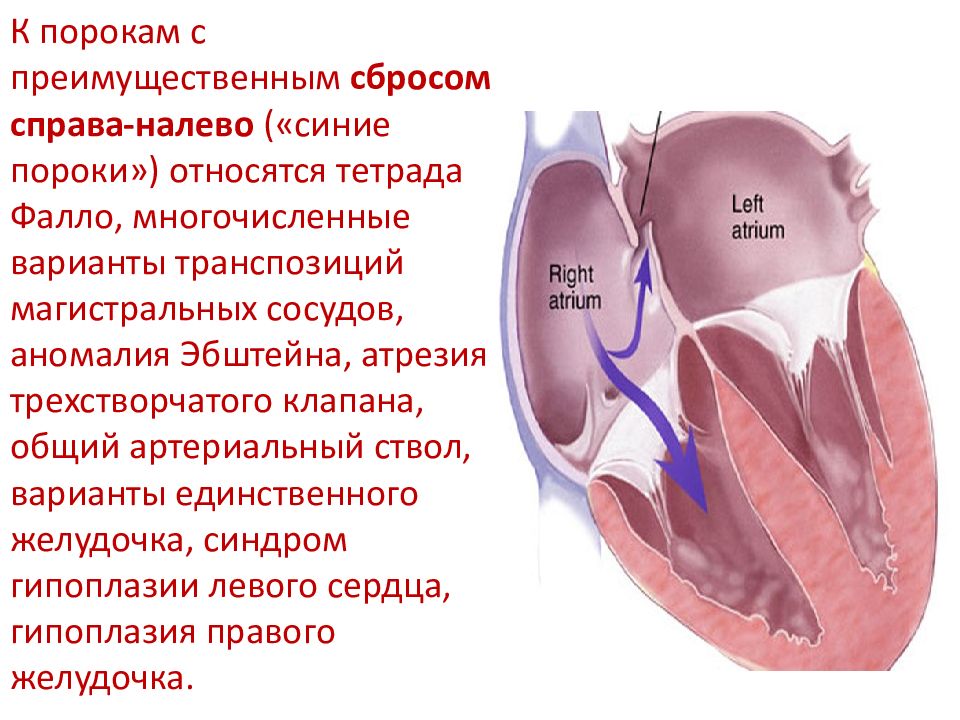 Врожденный порок сердца тетрада фалло презентация