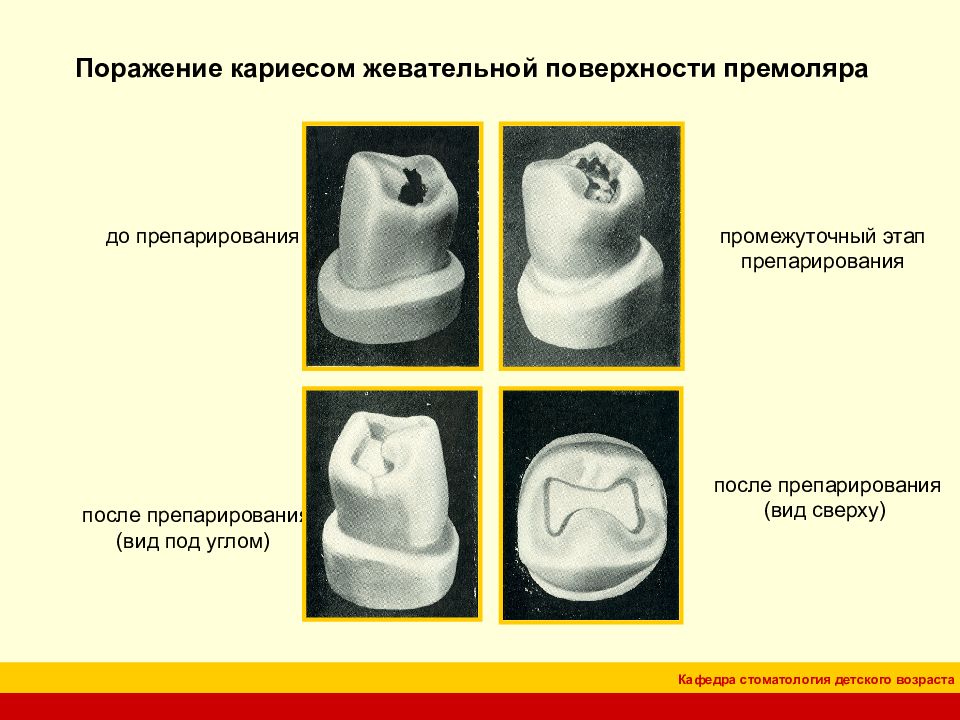 Классификация кариозных полостей по блэку презентация