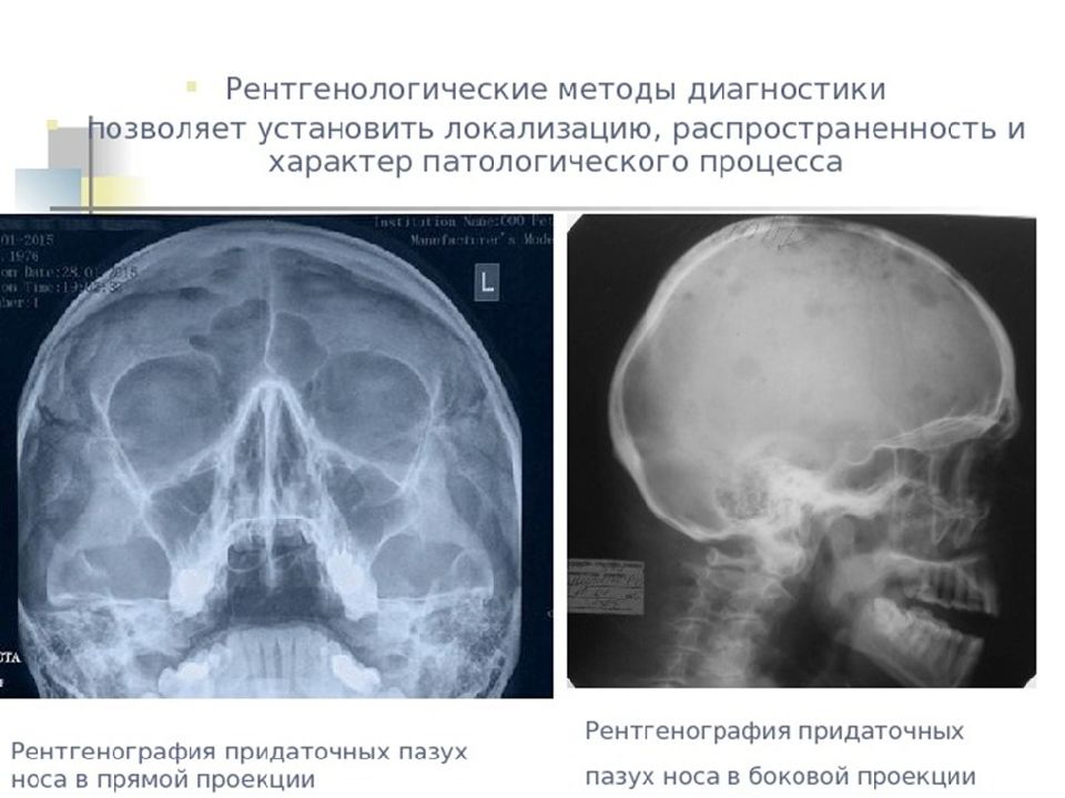 Лучевая диагностика в оториноларингологии и офтальмологии презентация