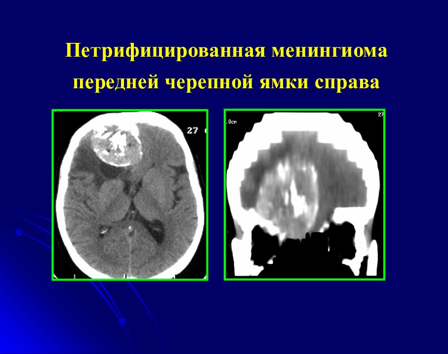 Менингиома на кт. Петрифицированная менингиома. Менингиома головного мозга кт. Обызвествленные менингиомы на кт. Менингиома ольфакторной ямки кт.