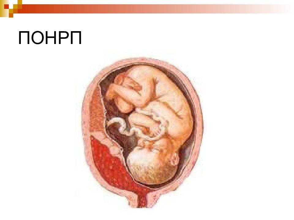 Отслойка нормальной плаценты. Преждевременная отслойка нормально расположенной плаценты (ПОНРП).