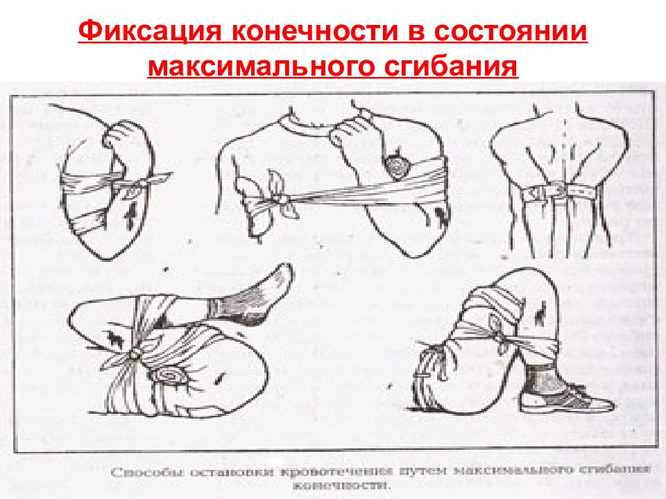 Максимальное сгибание конечности. Метод максимального сгибания при кровотечении. Метод максимального сгибания конечности при кровотечении. Максимальное сгибание конечности при кровотечении. Фиксированное сгибание конечности.