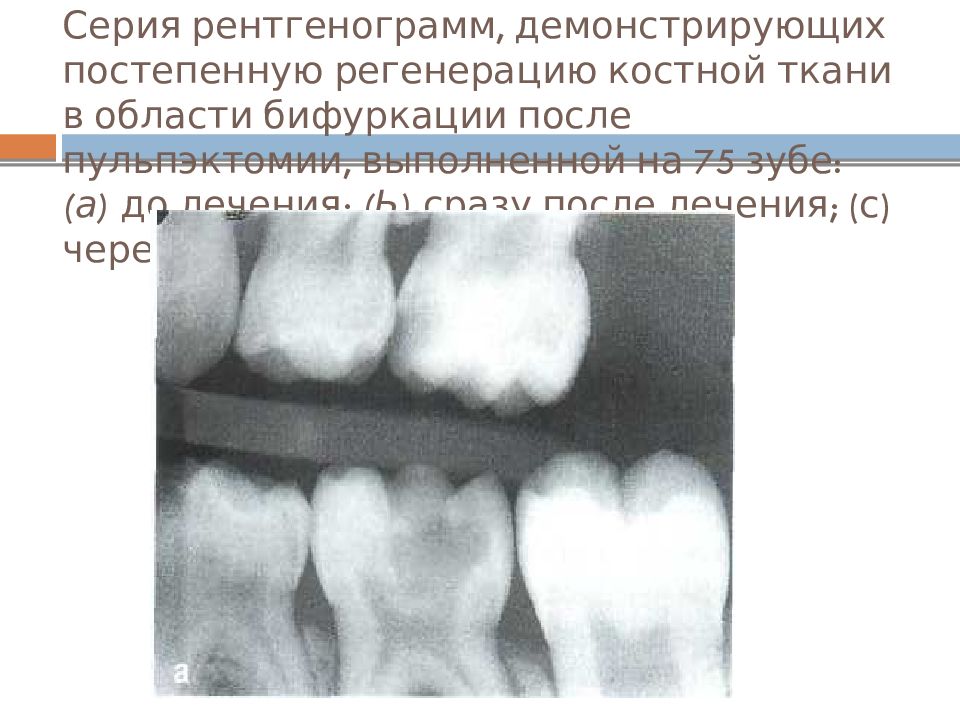 Этиология патогенез пульпита презентация