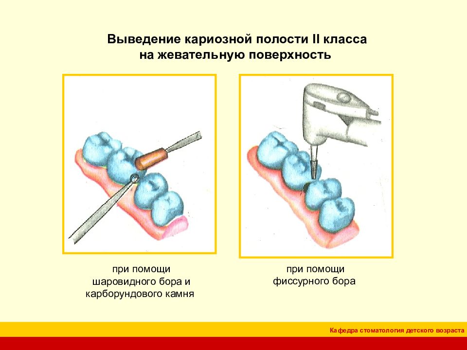 Препарирование кариозных полостей по блэку презентация