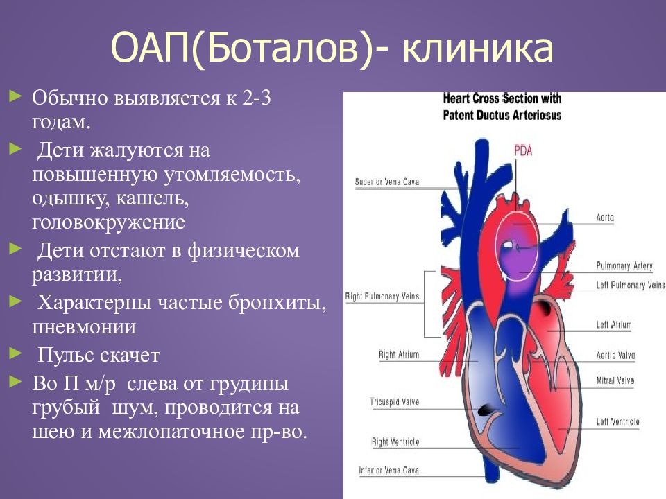 Открытый артериальный проток у детей презентация