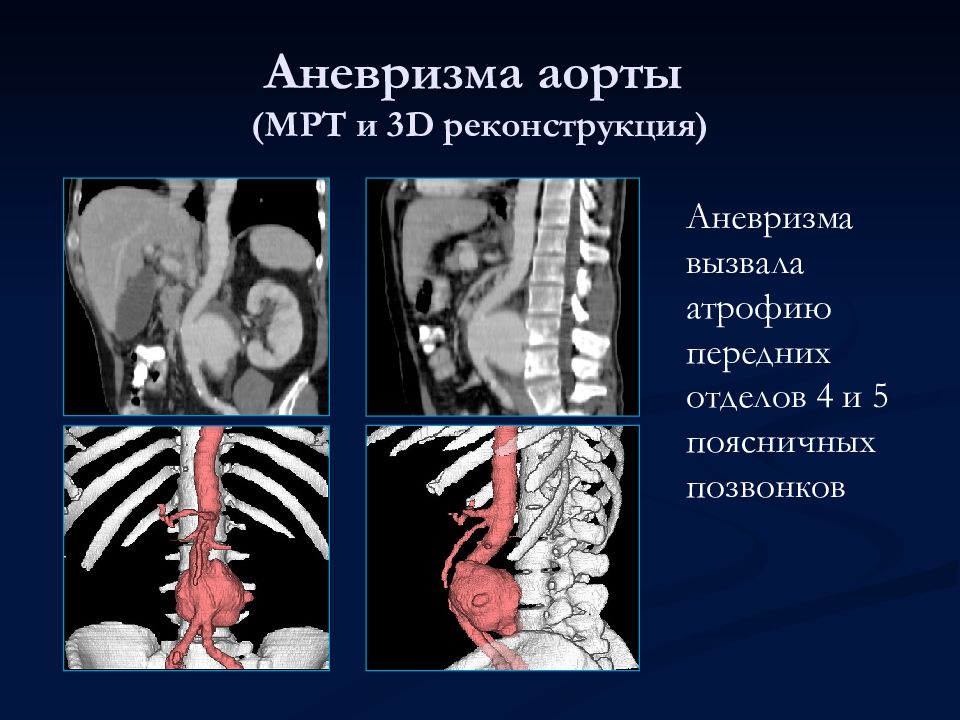 Аортит. Аневризмы грудной аорты.