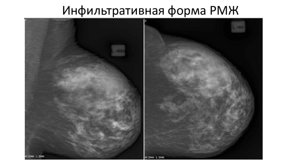 Шишка в грудной железе у женщин. Карцинома молочной железы маммография. Рик молочной железы маммографич. Протоковая карцинома молочной железы маммография. Отечно-инфильтративная форма.