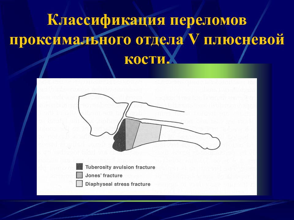 Закрытый перелом костей плюсны карта вызова