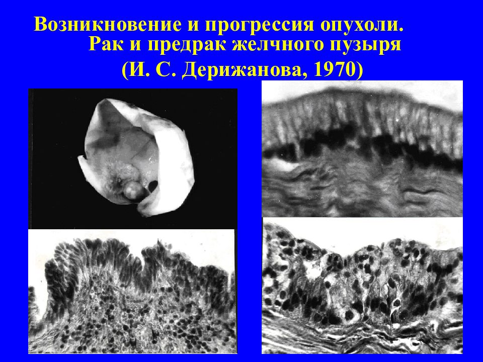 Опухолевая прогрессия презентация