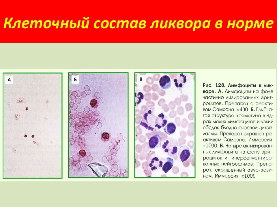 Нормальная клетка. Лимфоциты и нейтрофилы в ликворе. Цитология ликвора микроскопия. Исследование спинномозговой жидкости лимфоциты. Цитоз лимфоциты в ликворе.