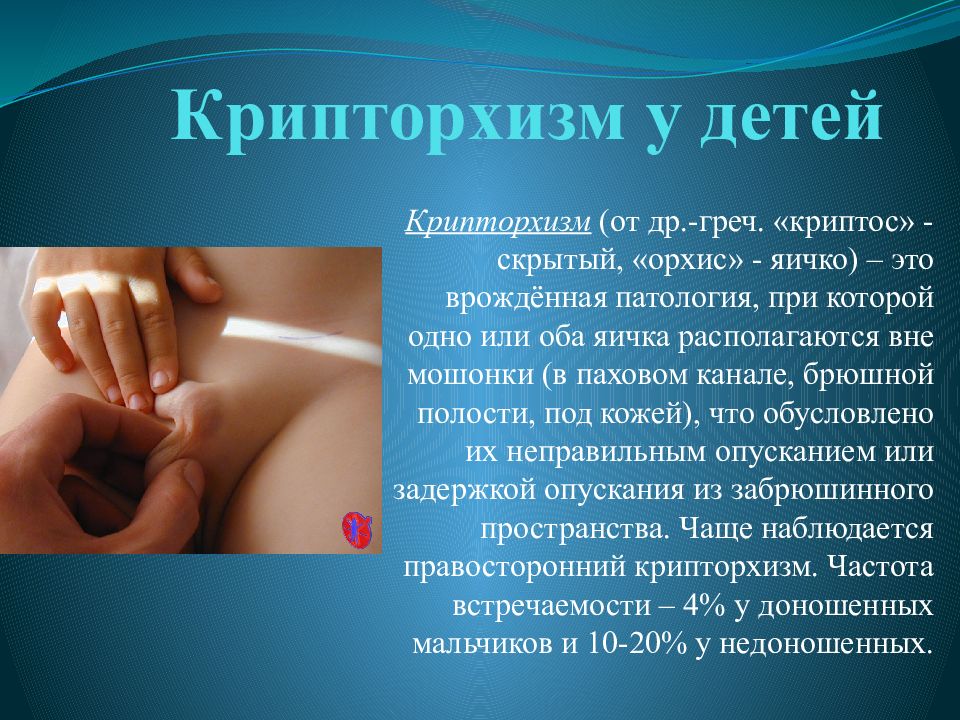 Крипторхизм у детей