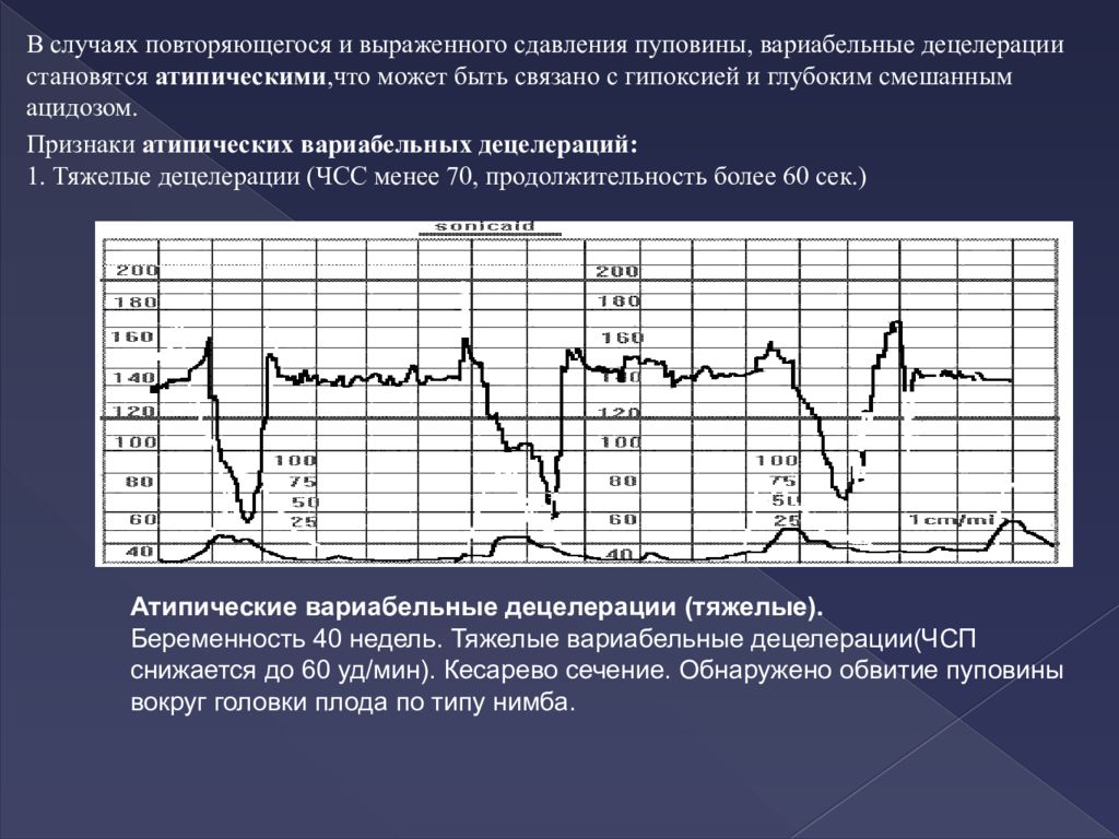 Акселерация на ктг. КТГ плода расшифровка акцелерации и децелерации. Кардиотокография плода расшифровка. Вариабельные децелерации на КТГ. Акселерация и децелерация на КТГ.